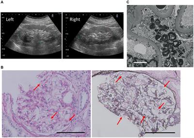 Late-onset renal variant Fabry disease with R112H mutation and mild increase in plasma globotriaosylsphingosine: a case report